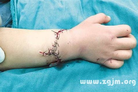 梦见手被切断是什么意思